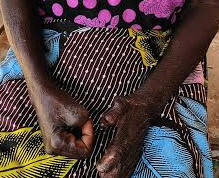 Touba mobilisée contre la lèpre : des cas récents relancent l’alerte sanitaire